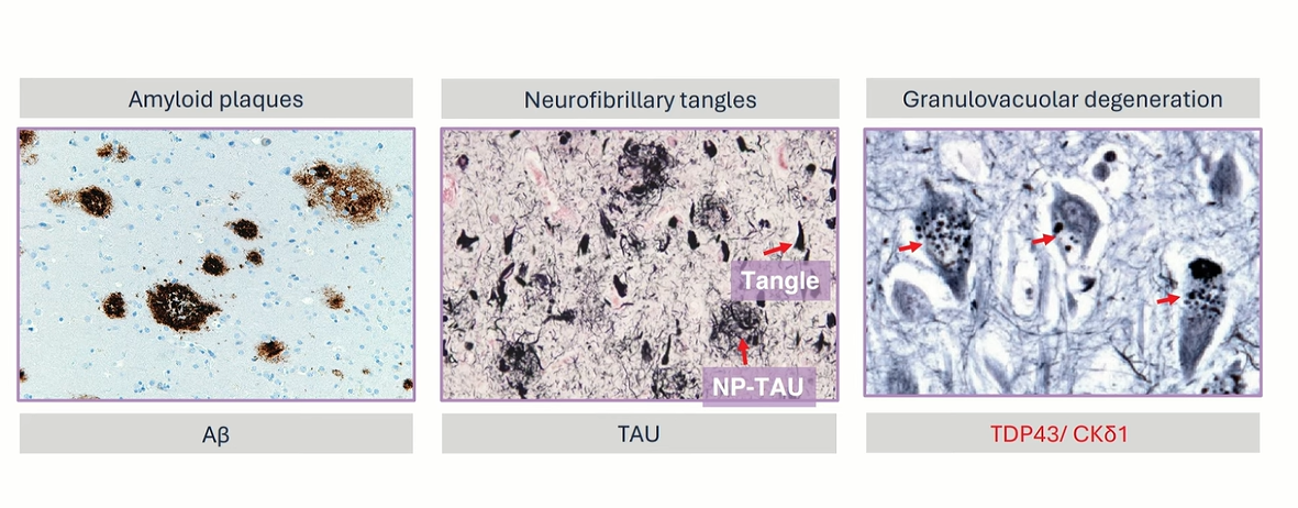 Three histological images showing extracellular amyloid plaques, intracellular tau tangles, and granulovacuolar degeneration in Alzheimer’s disease.