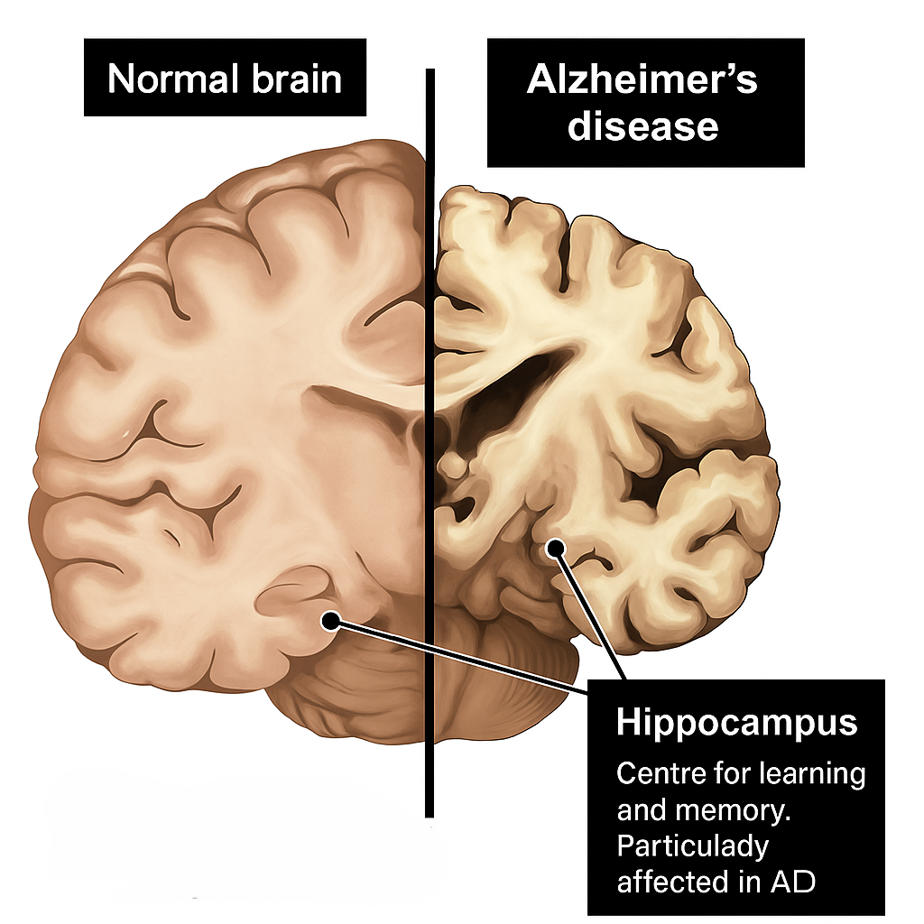 Side-by-side illustration showing a normal brain and an Alzheimer’s disease brain with marked brain shrinkage and hippocampal atrophy.