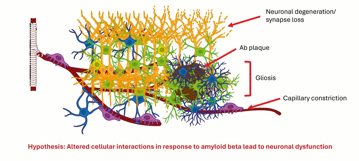 Diagram showing an amyloid plaque surrounded by neurons, glial cells, and blood vessels, with gliosis, capillary constriction, and synaptic degeneration.